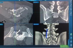Navigation Orthopédique pour chirurgie vertébrale 