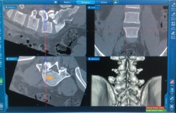 Navigation orthopédique pour chirurgie vertébrale 